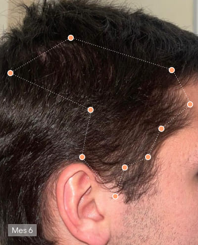 Depois de 6 meses com Olistic Men – resultado capilar 2