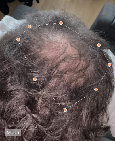 Depois de 6 meses com Olistic Men – resultado capilar 3