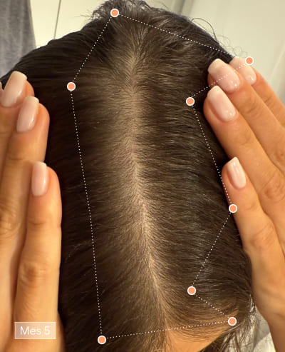 Depois de 6 meses com Olistic Women – resultado paciente 3