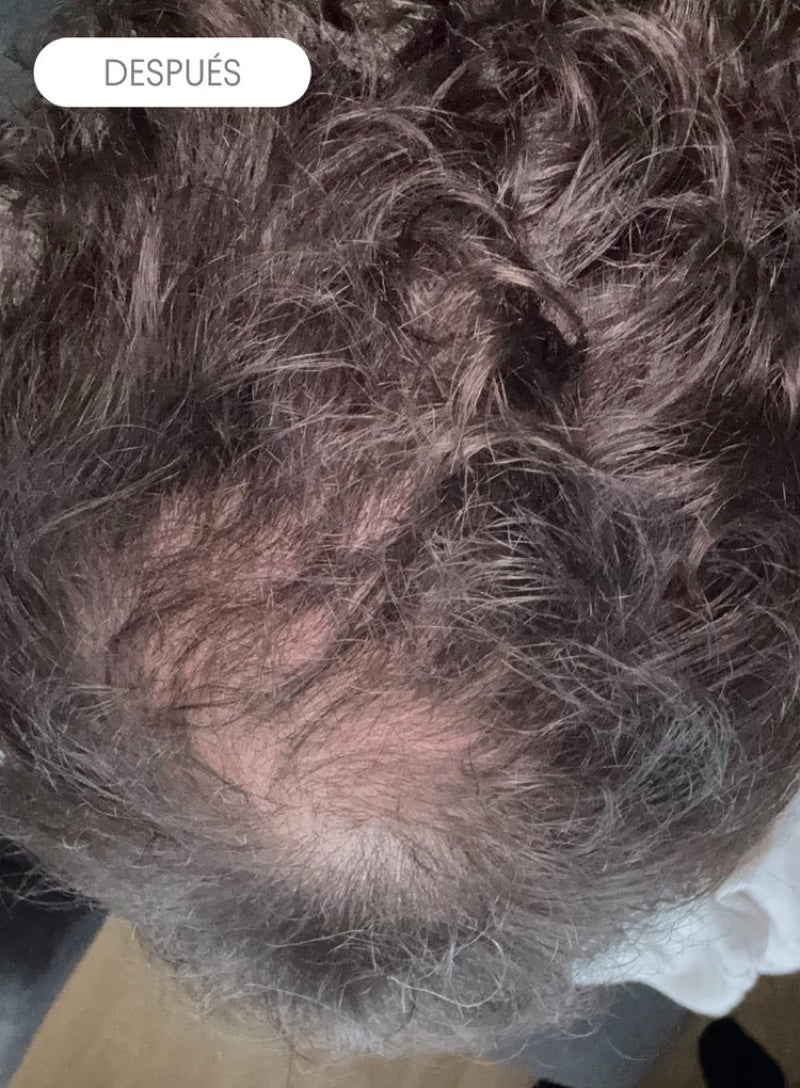 Cuero cabelludo tras 6 meses con Olistic Men + Night